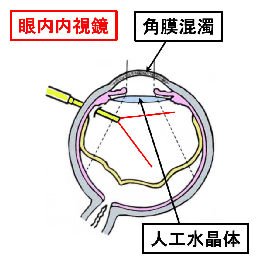 眼内内視鏡