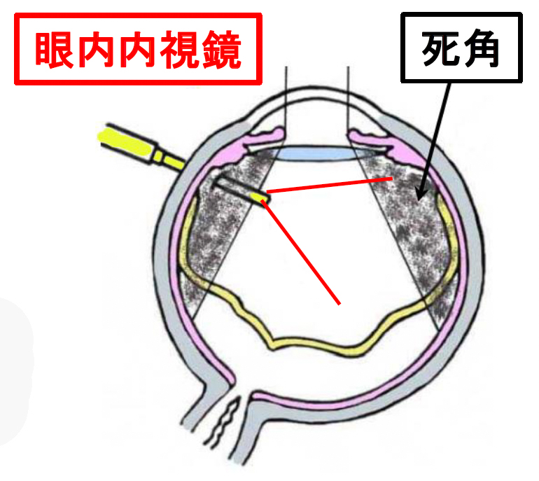 眼内内視鏡