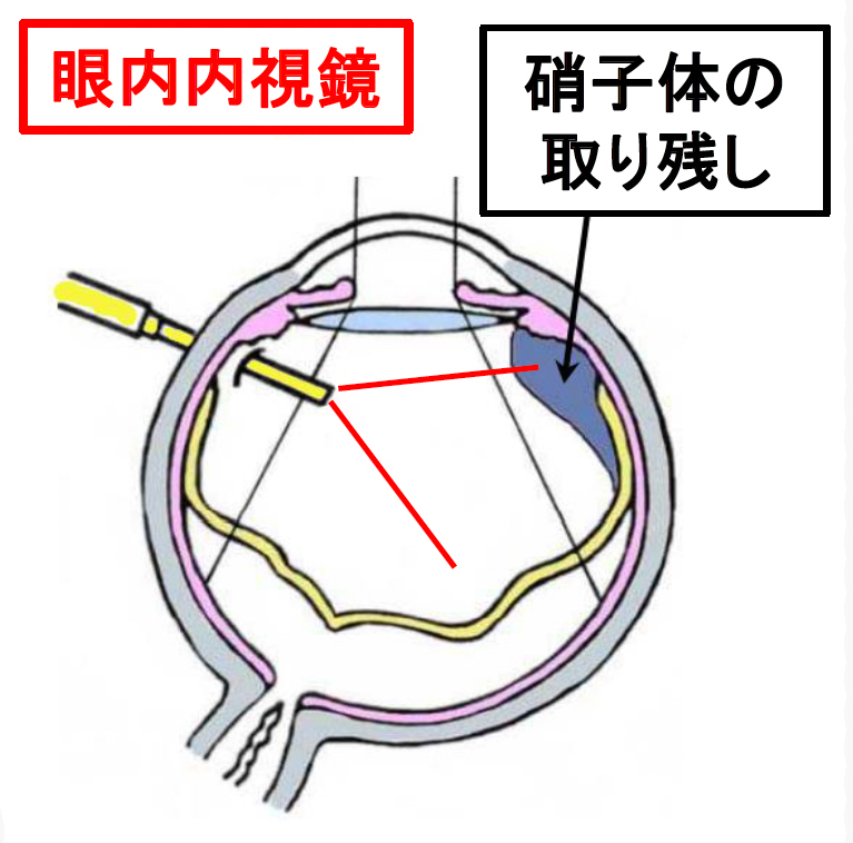 眼内内視鏡