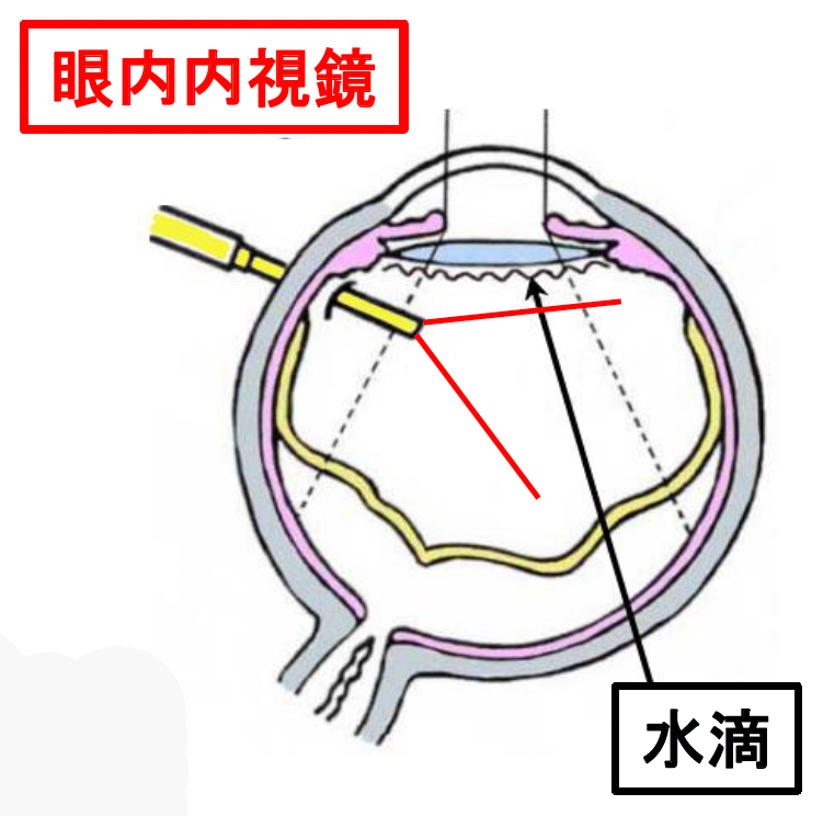 眼内内視鏡