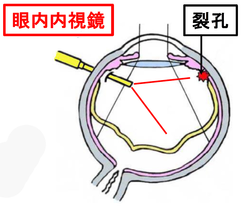 眼内内視鏡