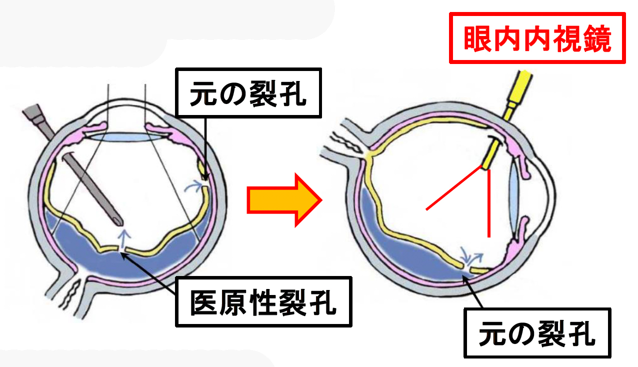 眼内内視鏡